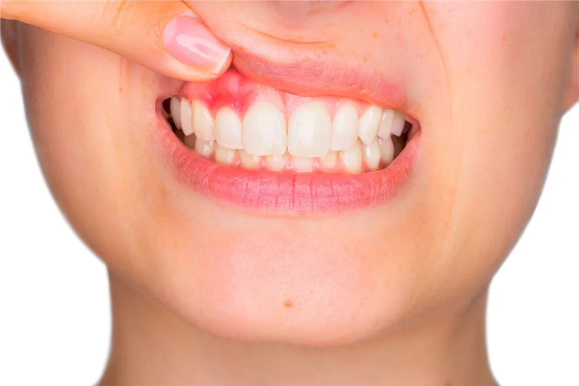 Türkiye Diş Eti Hastalıkları Tedavisi | Periodontoloji 3Gün